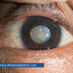 Cataract