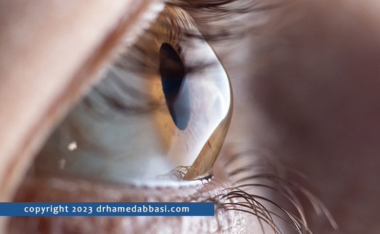 Keratoconus